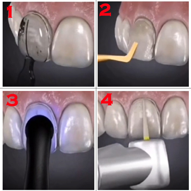 Набор для отбеливания зубов, 3 – обзор и цена Teeth Whitening Moulds