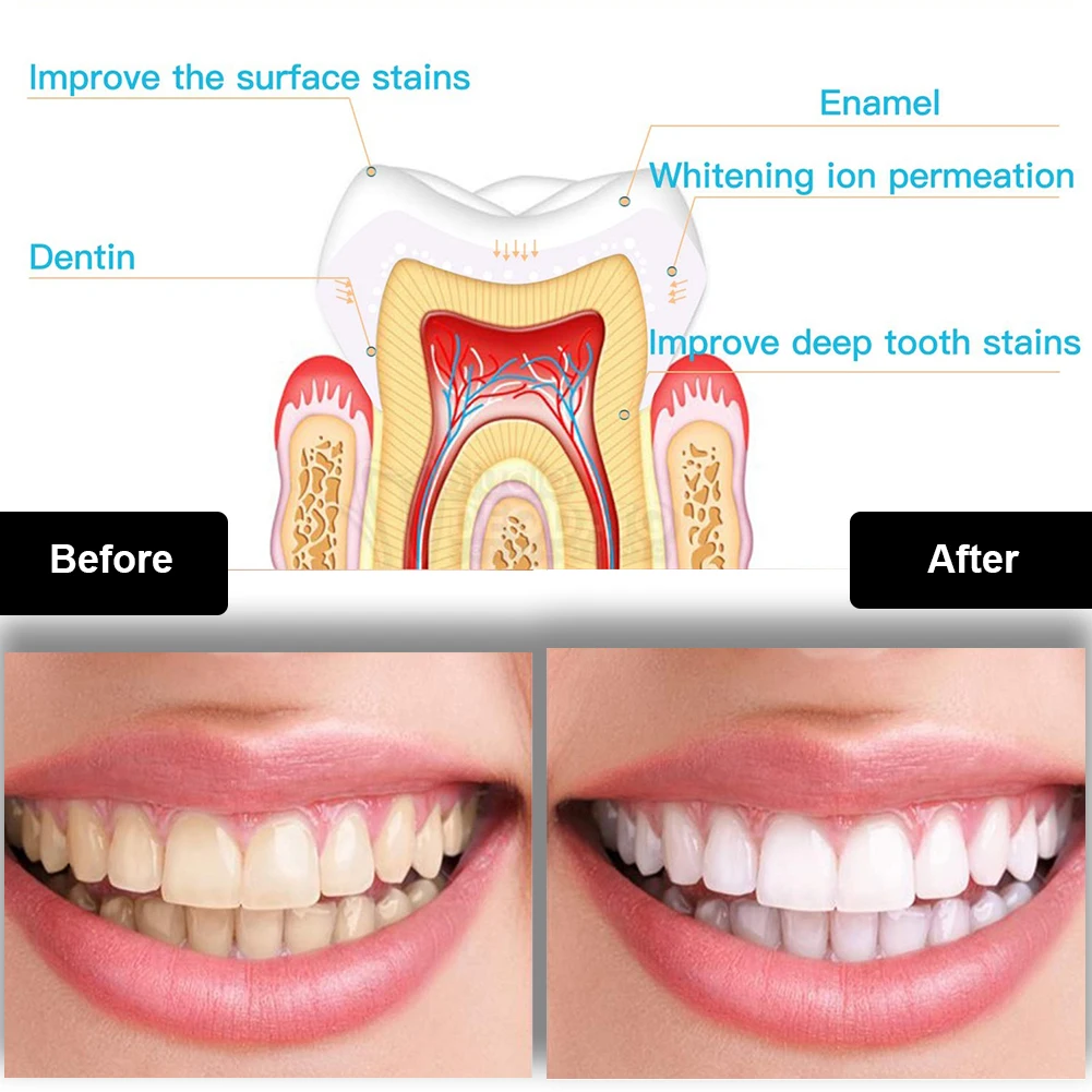Набор для отбеливания зубов, м – обзор и цена Teeth Whitening Pens